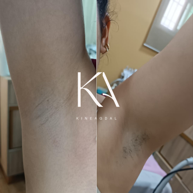 Résultat avant après d’une épilation laser à Rabat au Centre Laser Kine Agdal 